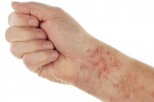 Allergies due to parasites in the body